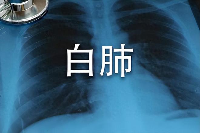 中老年人警惕白肺！肺炎成因及预防全知道，与新冠疫情有关联吗？